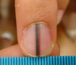 爪甲色素線条 爪甲色素線条
